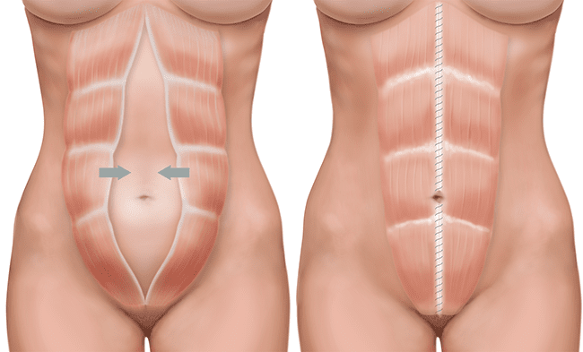 How to check if you have abdominal separation after pregnancy.